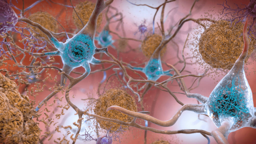In the Alzheimer's-affected brain, abnormal levels of the amyloid beta protein clump together.