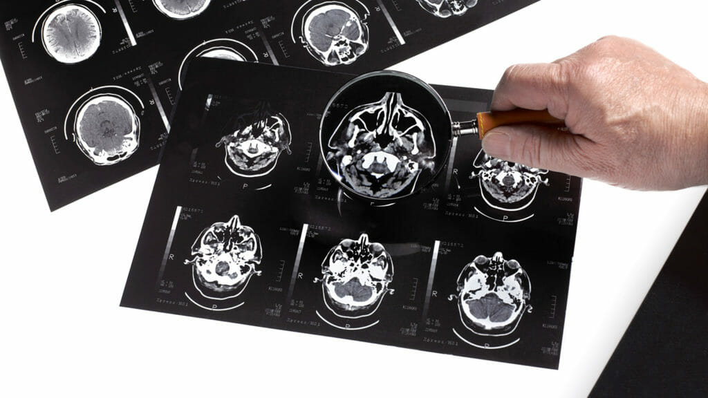 Non-invasive brain tech joining drug solutions among emerging Alzheimer’s treatments