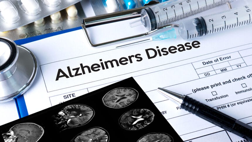 Alzheimers Disease concept , Brain degenerative diseases Parkinson